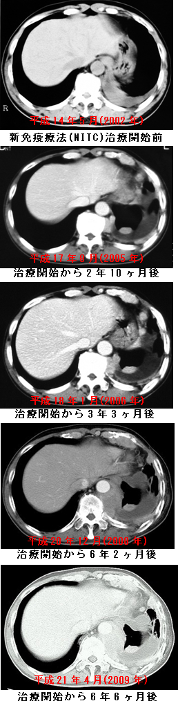 悪性胸膜中皮腫　CT比較画像　新免疫療法によるがん免疫療法