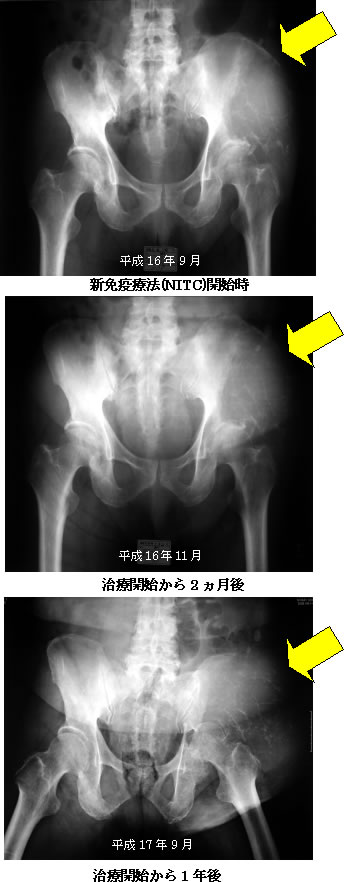 転移性骨腫瘍の検査画像の推移