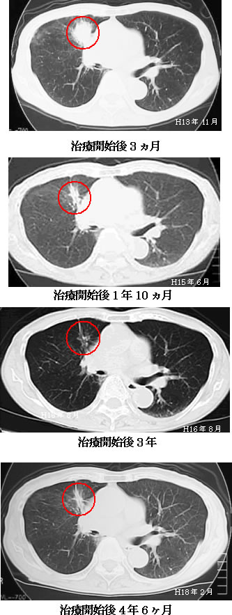 肺腺癌　CT検査画像の推移