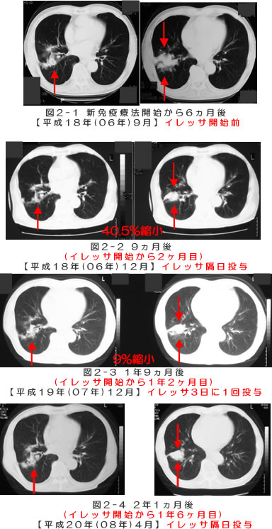肺腺癌　CT検査画像の推移