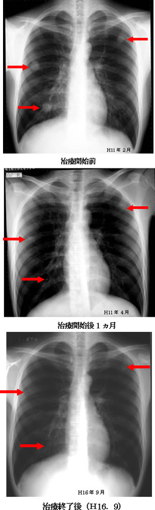 精巣癌　肺転移　レントゲン写真の推移