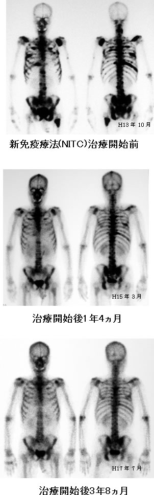 前立腺がん　多発骨転移　比較画像　骨シンチ