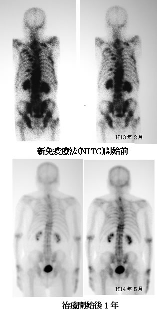 前立腺がん　骨転移　比較画像
