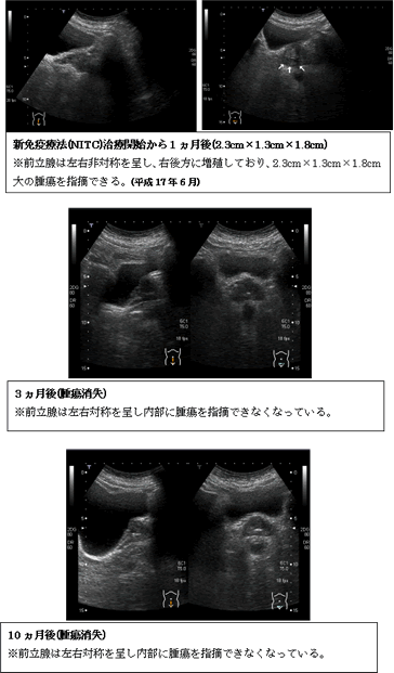 前立腺がん　比較画像