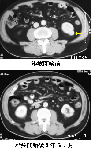 腎臓がん　主病変　CT検査画像の推移