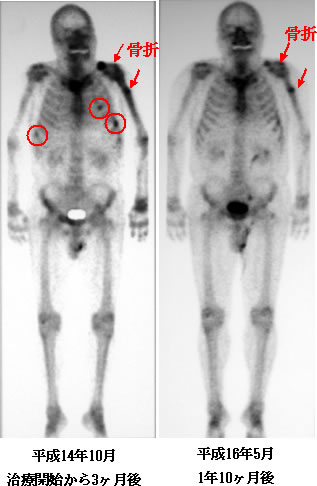 腎臓がん　骨転移　比較画像