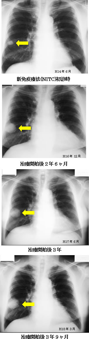 腎臓がん　レントゲン写真の推移