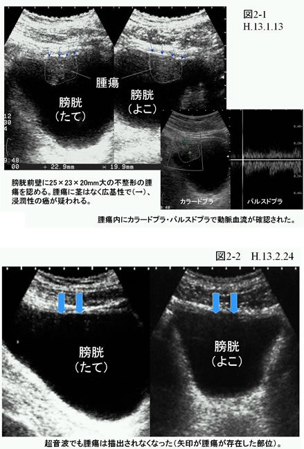 尿管腫瘍(移行上皮癌)　比較画像