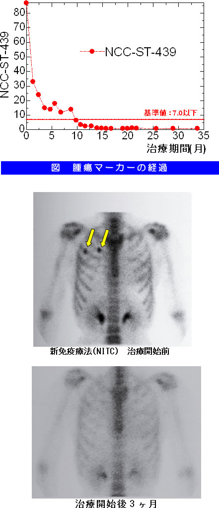 乳癌　骨転移　症例　骨シンチの比較および腫瘍マーカーの推移
