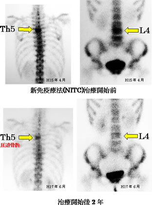 乳癌　骨転移　症例　骨シンチ比較