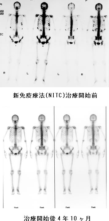 乳癌　症例　骨シンチ画像　比較