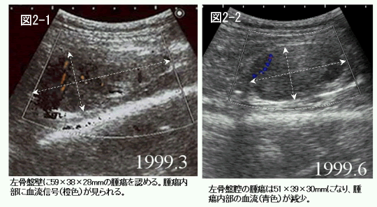 子宮体がん　症例　比較画像1