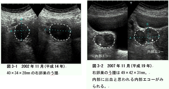 乳がん　症例　超音波検査画像比較2