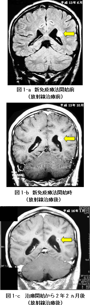脳腫瘍　星状細胞腫瘍　症例　CT検査　比較