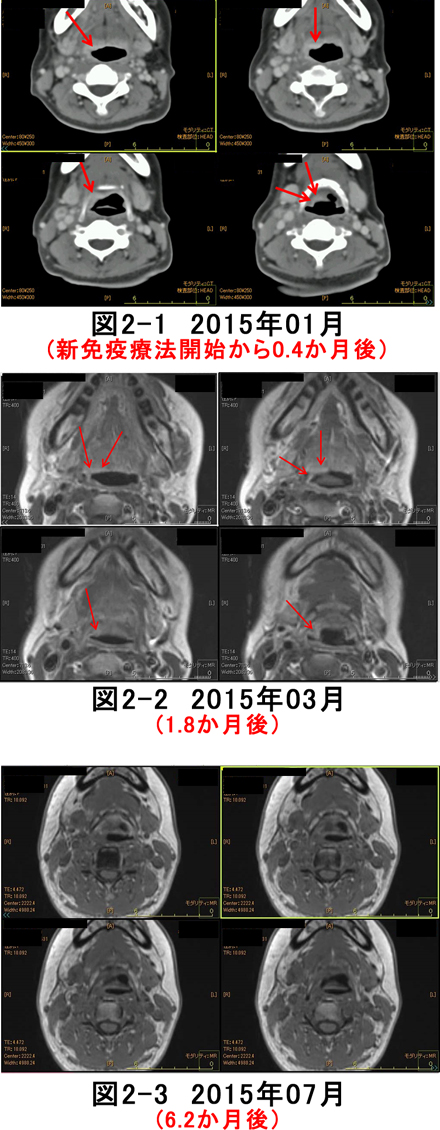 中咽頭癌　CT画像　MRI画像の比較
