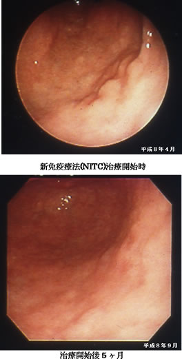 スキルス胃癌　症例　内視鏡検査比較