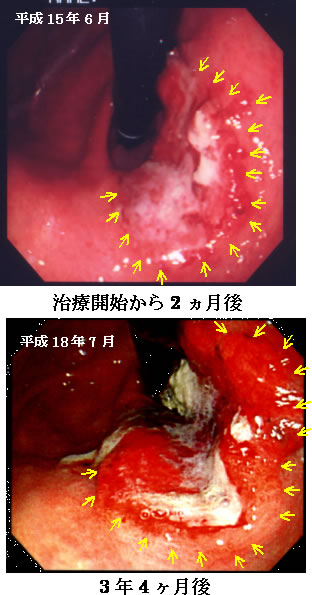 胃癌　症例　内視鏡の比較