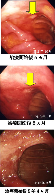胃癌　症例　内視鏡検査の比較