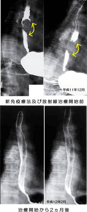 食道癌　症例　比較画像