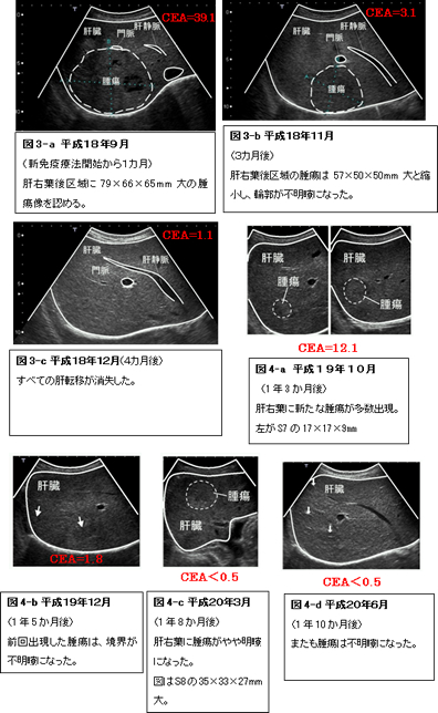 大腸癌(S状結腸癌) 症例 肝臓転移 超音波検査の推移