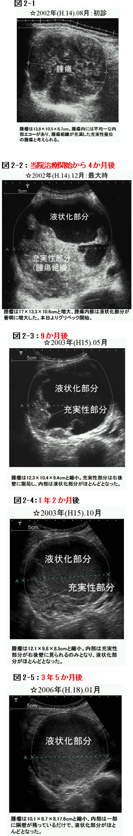 後腹膜腫瘍　症例　超音波検査比較