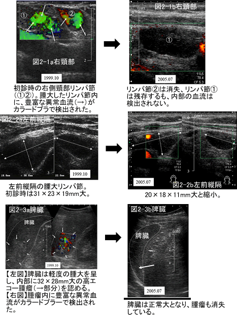 悪性リンパ腫　症例　超音波検査画像　比較