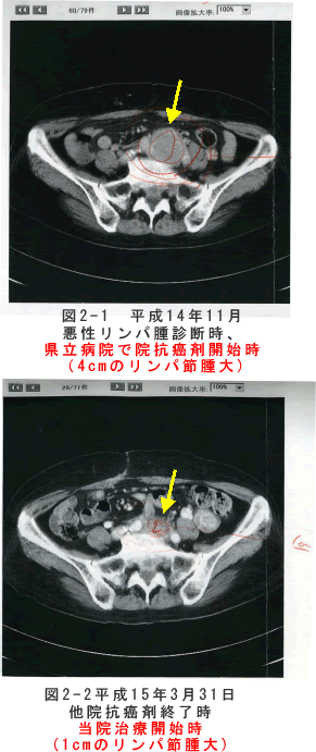 悪性リンパ腫　症例　CT検査の比較
