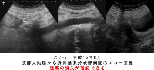 悪性リンパ腫　症例　超音波検査画像